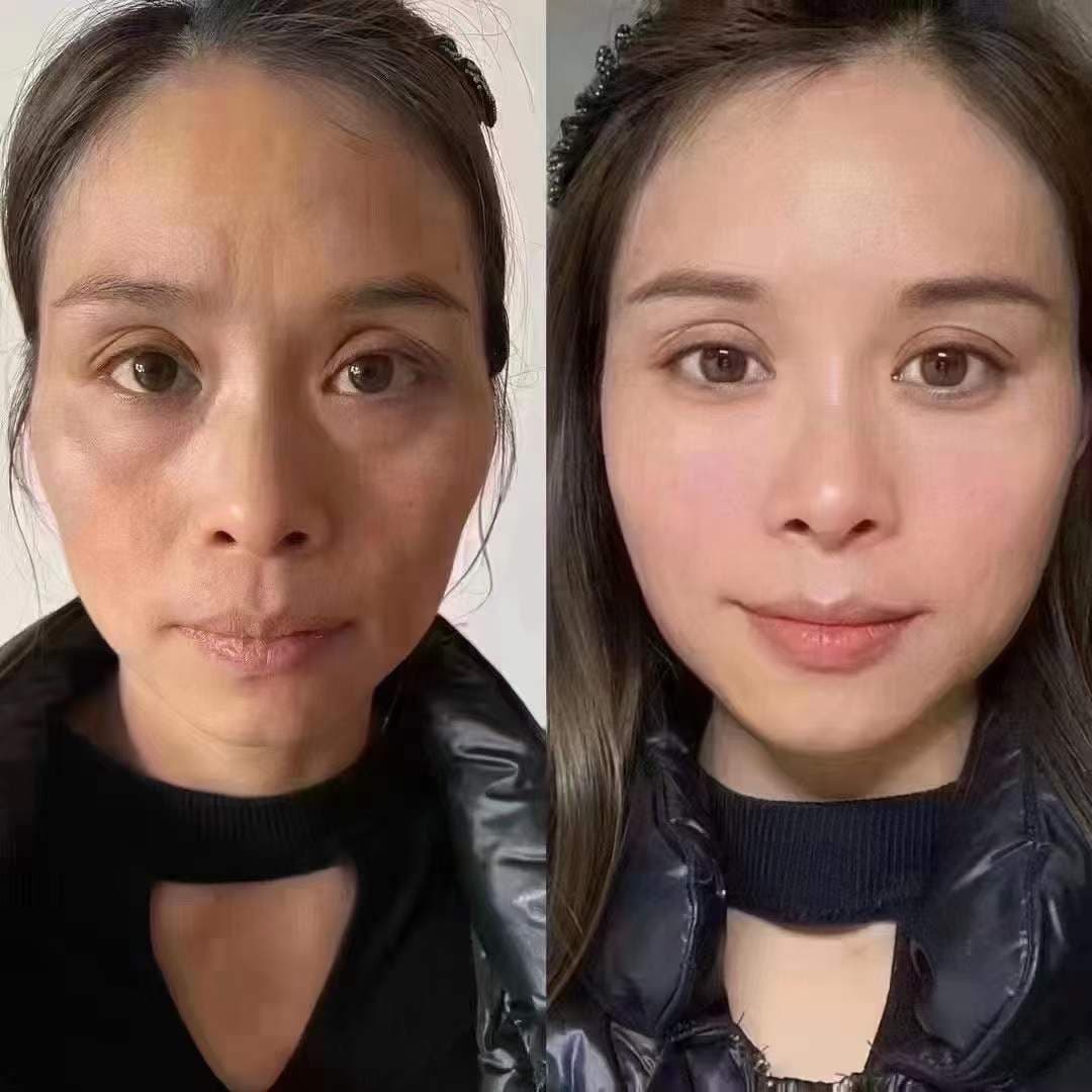 Ellanse Collagen Stimulation