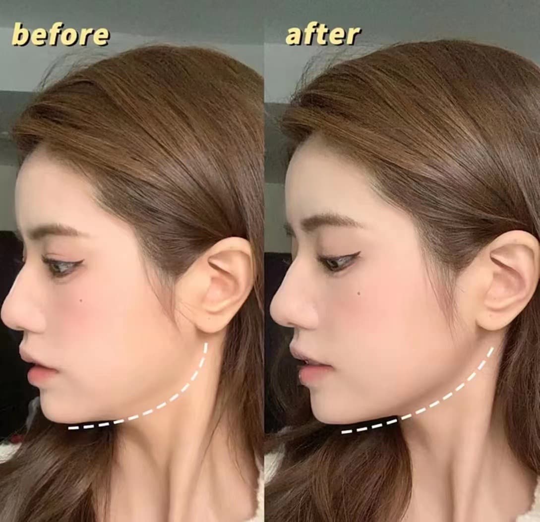 Jawline Contouring
