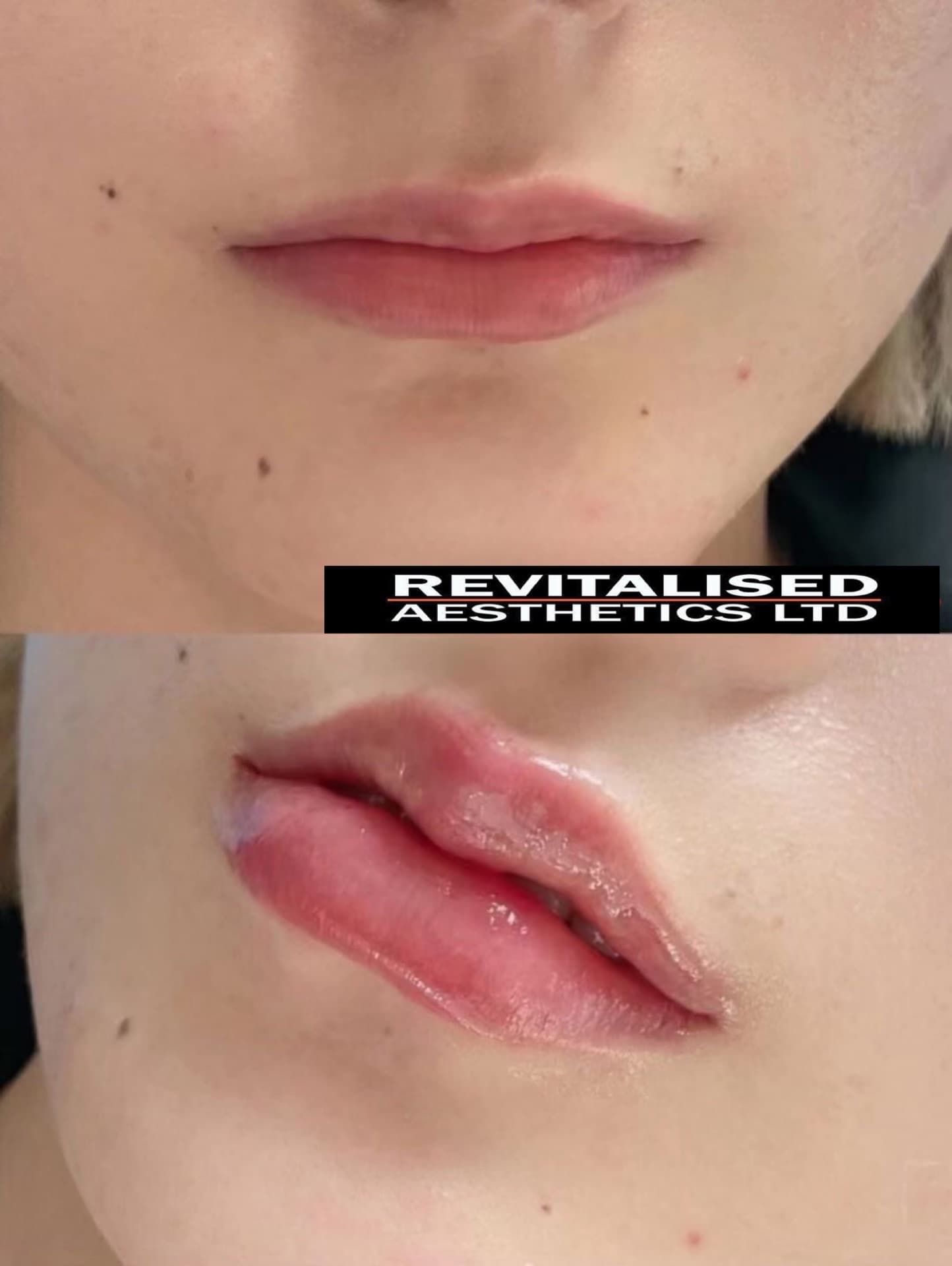 Lip Enhancement