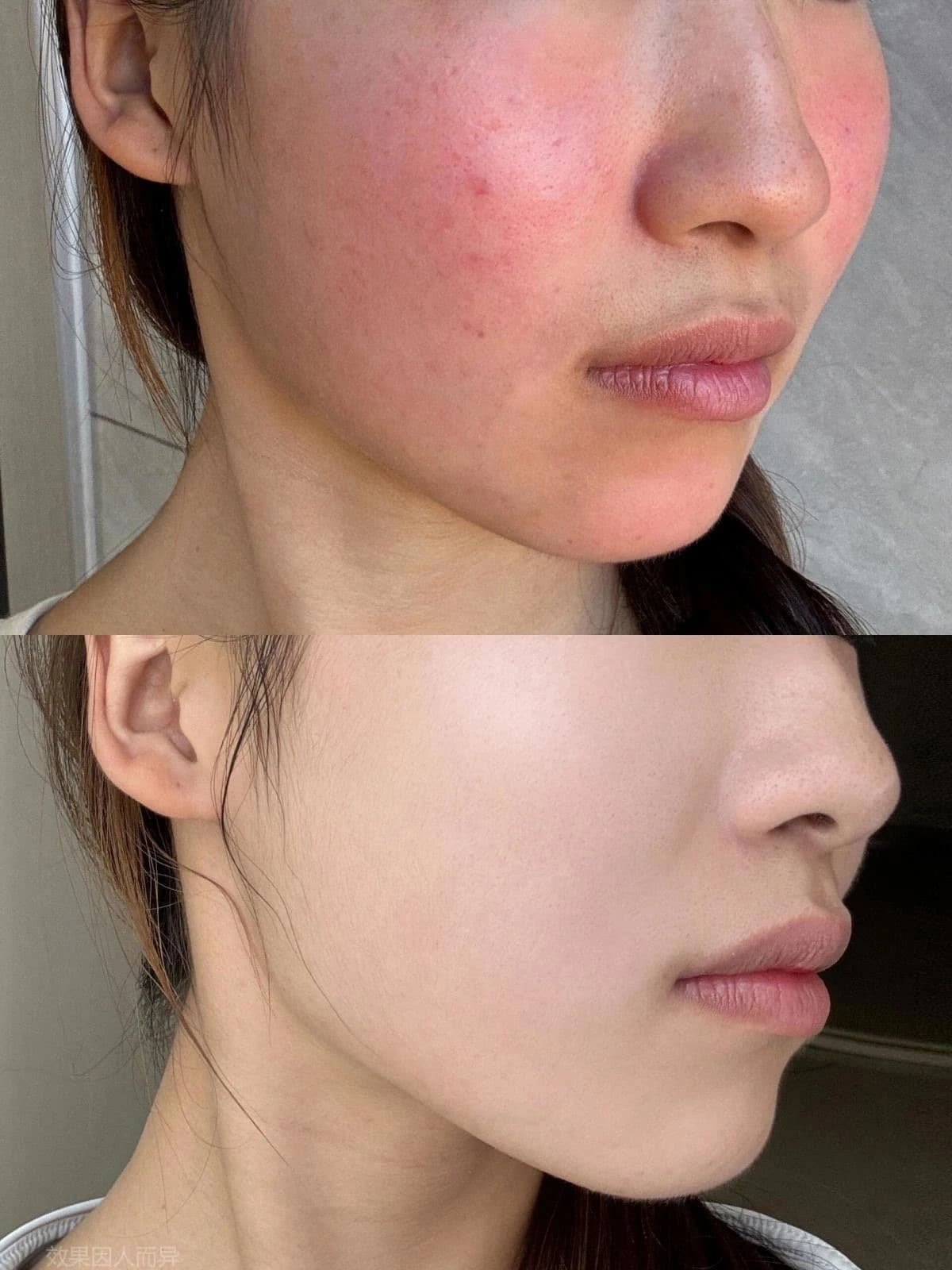 Acne & Redness Treatment