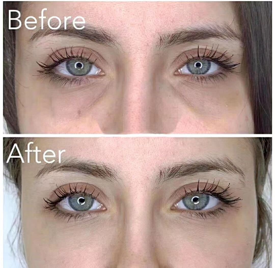 Under-Eye Rejuvenation